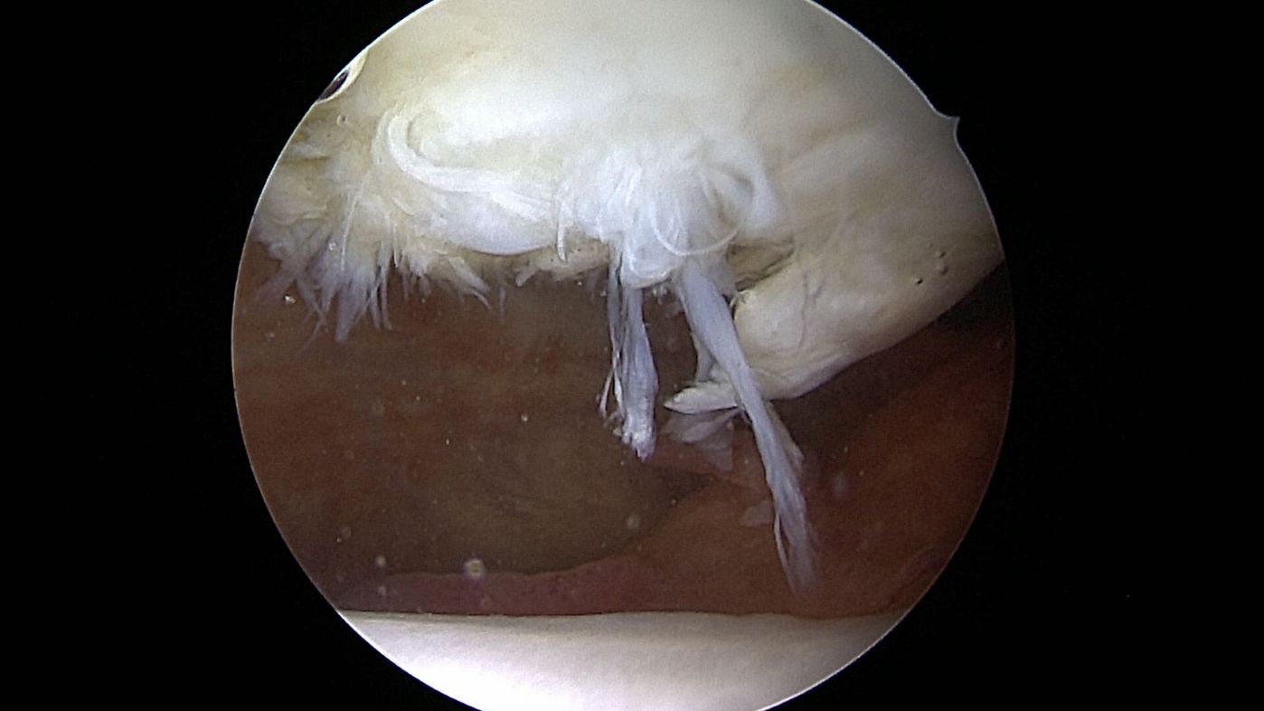 knorpeltransplantation-orthopaedie-unfallchirurgie-waldkrankenhaus-erlangen